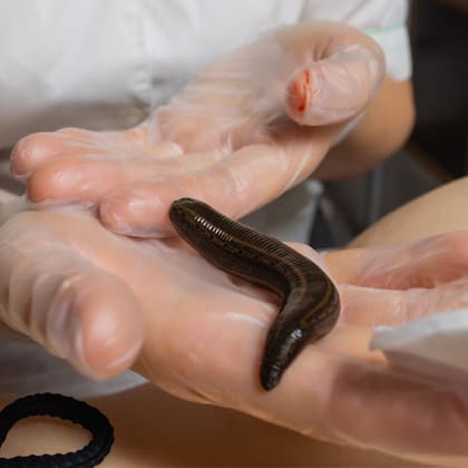 Leech Therapy
